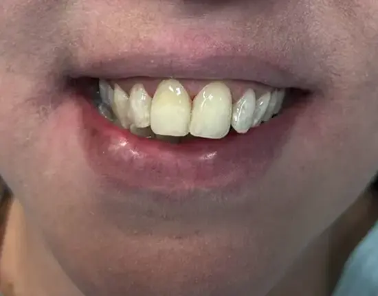 Composite-Venners_after copy