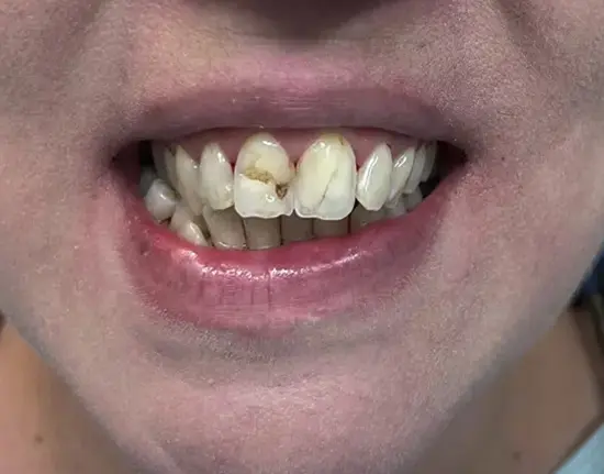 Composite-Venners_before copy