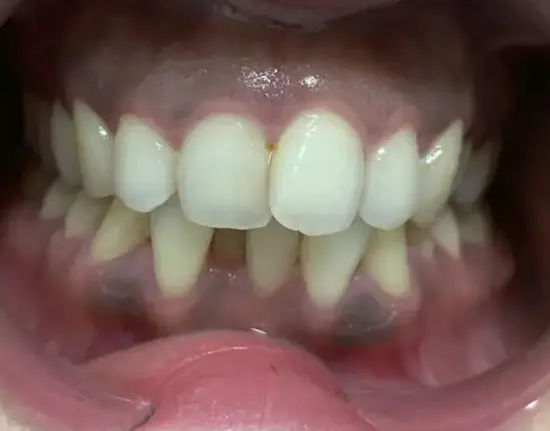 Invisalign_after copy