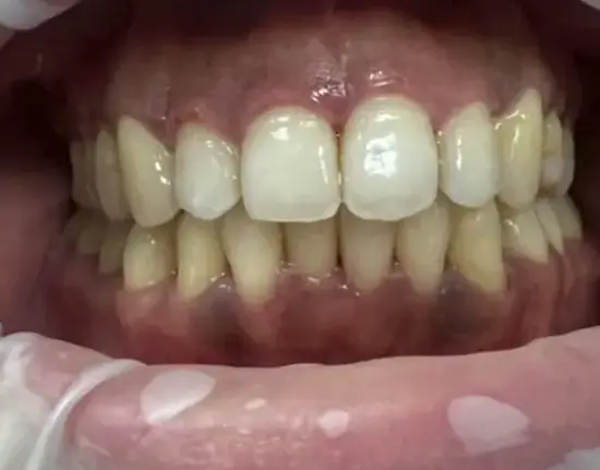 Invisalign_before copy