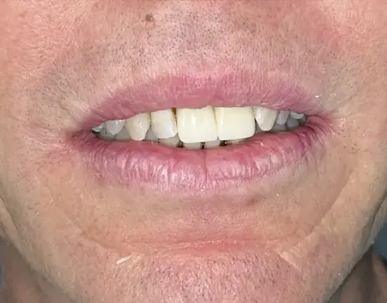 Porcelain-Crown-Replacement-after1 copy