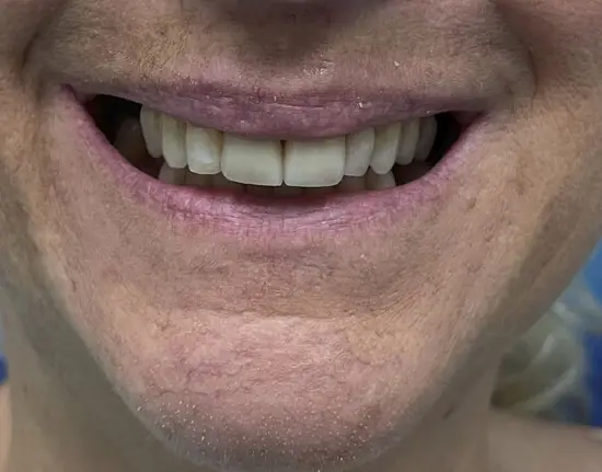 Porcelain-Crown_after copy