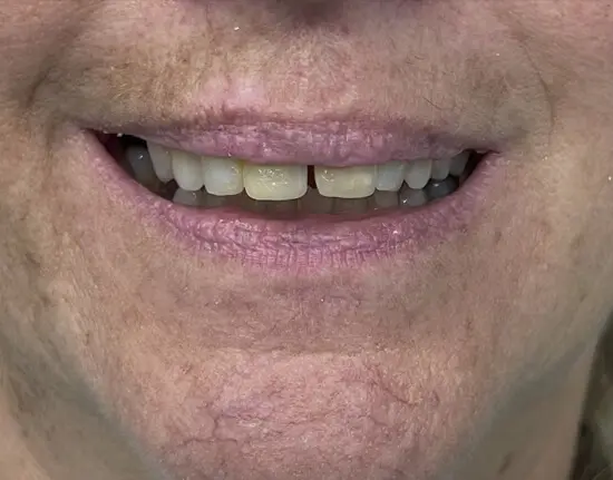 Porcelain-Crown_before copy