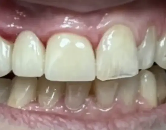 after1Porcelain copy