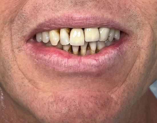 Porcelain-Crown-Replacement-after1-copy