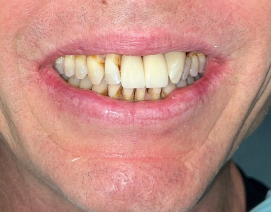 Porcelain-Crown-Replacement-after1-copy2