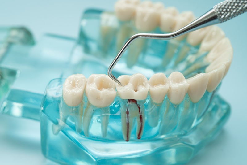 Dental teeth model with dentist tool for root canal.