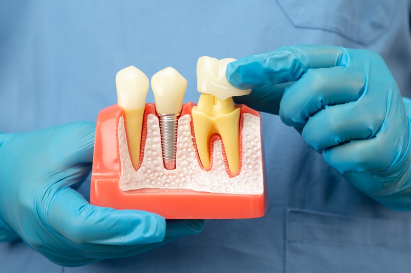 Asian dentist holding dental crown, artificial tooth roots into jaw, root canal of dental treatment, gum disease, teeth model for dentist.