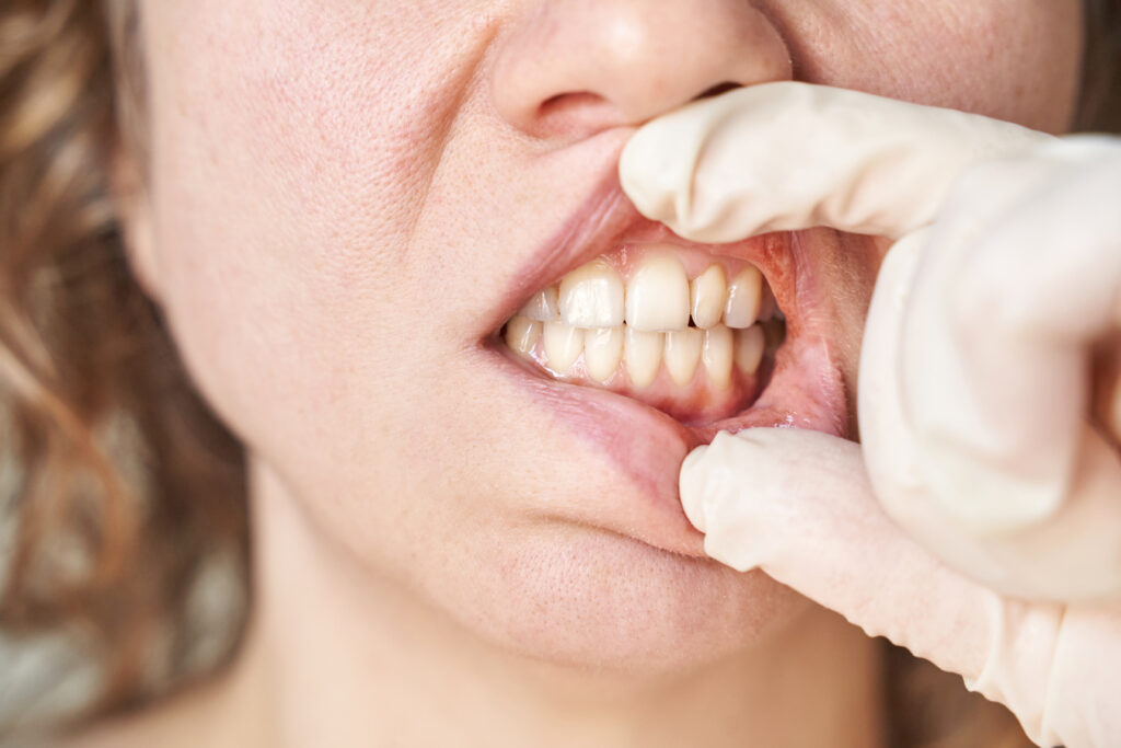Dentist pulling back a patient's lip to examine receding gums and exposed tooth roots