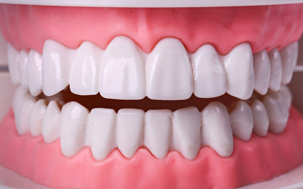 Dental model of upper and lower teeth with pink gums, used to explain bleeding gums when brushing